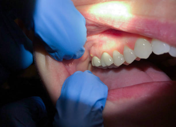 Teeth Whitening in TN